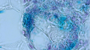 Tumore seno, farmaco aumenta sopravvivenza senza peggioramento