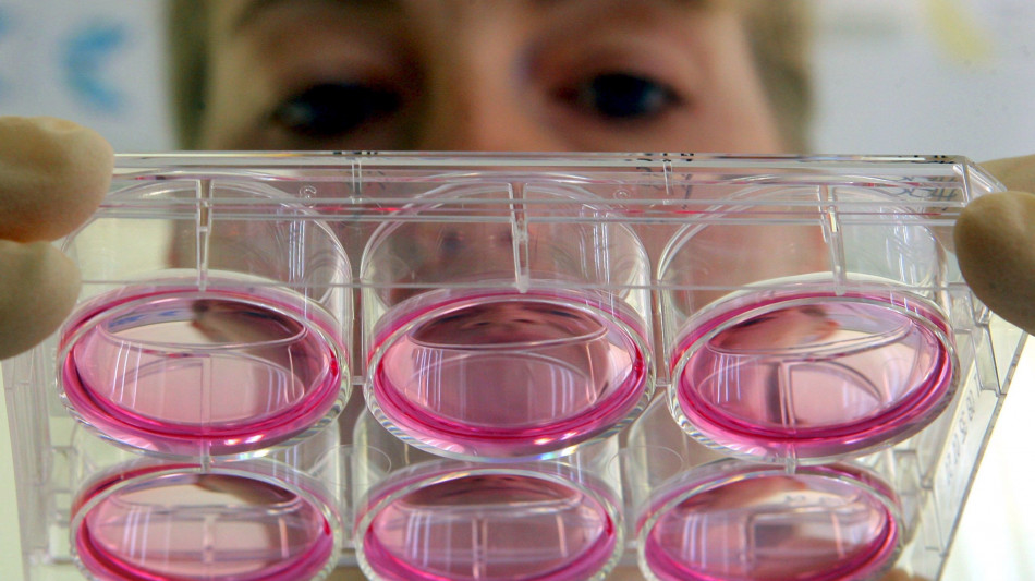 Lotta all'Alzheimer, le connessioni cerebrali aprono nuova via