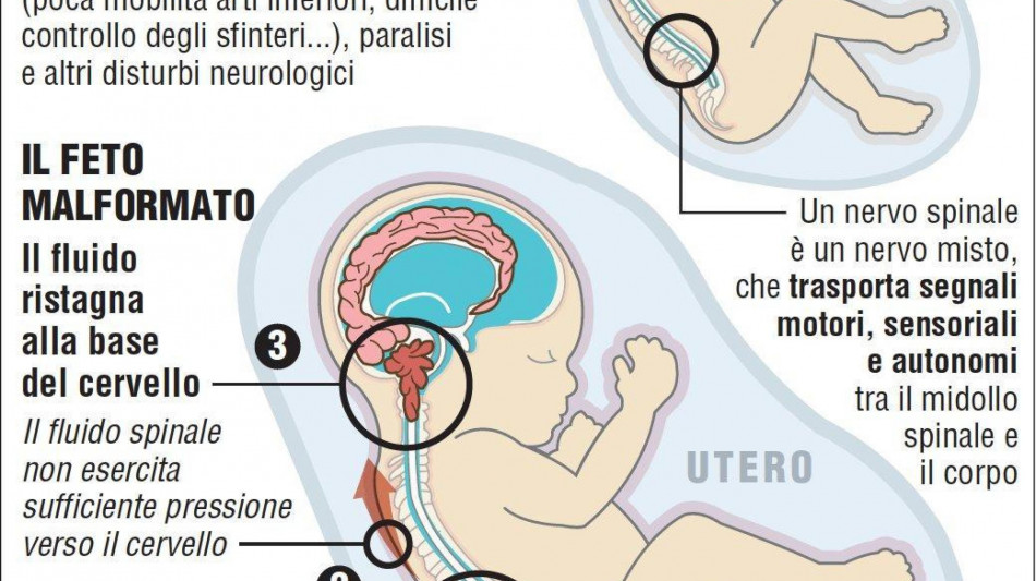 Spina bifida, sei interventi in utero con le staminali