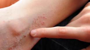L'orticaria cronica spontanea costa ai pazienti oltre 4mila euro all'anno